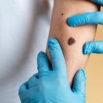 Melanom – koji su rizici za pojavu melanoma i kako se zaštititi?