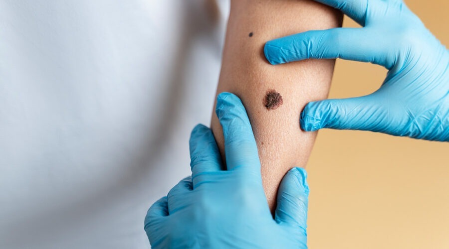 Melanom – koji su rizici za pojavu melanoma i kako se zaštititi?